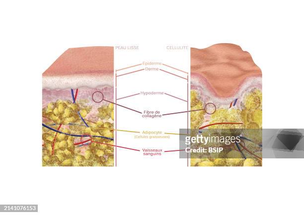 Section of skin with cellulite compared to a section of smooth skin, with color legend, epidermis, dermis and hypodermis, collagen fiber, adipocyte...
