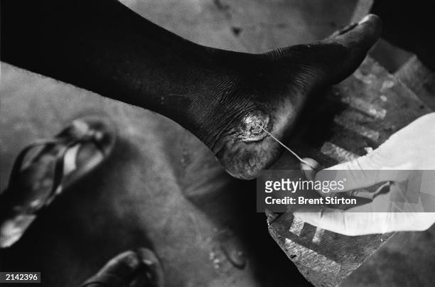Guinea worm is extracted from the ankle of its victim February 2003 in rural Ghana. Guinea worm is a parasitic worm which lives in the mud and water...