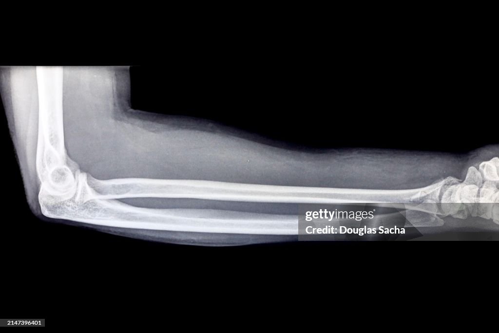 Forearm X-ray image with wrist and elbow