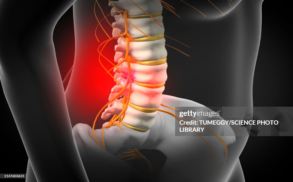Spinal disc herniation, illustration