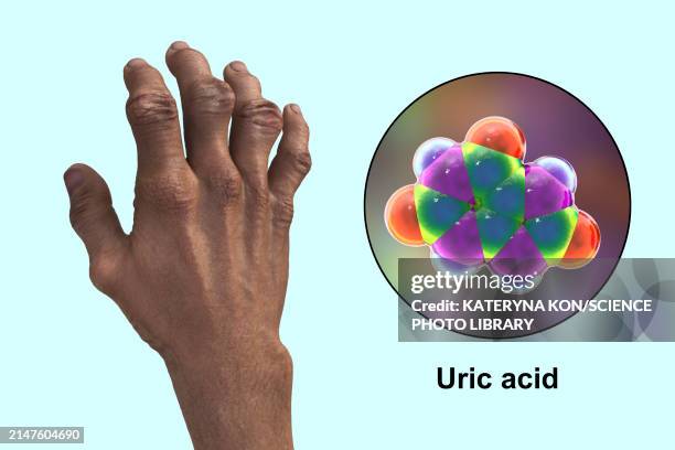 gout-afflicted hands with deformities, illustration - urine stock illustrations