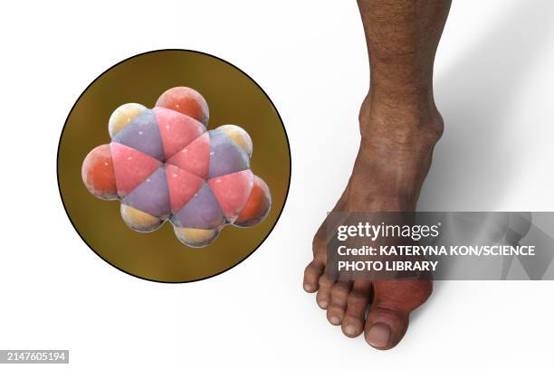 illustrazioni stock, clip art, cartoni animati e icone di tendenza di gout-afflicted foot, illustration - gotta