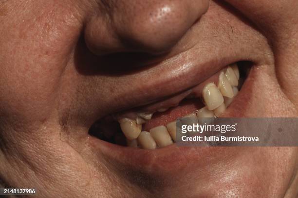 the woman's smiling mouth revealed missing front teeth, leaving a noticeable gap in her smile. - gingivitis stock-fotos und bilder