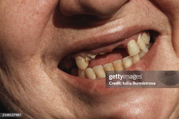 multiple missing teeth, visible dental plaque - gingivitis stock-fotos und bilder