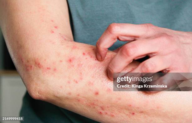 atopic eczema - dermatitis stock pictures, royalty-free photos & images