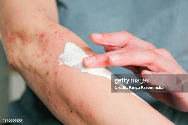 atopic eczema - eczema treatment stock pictures, royalty-free photos & images