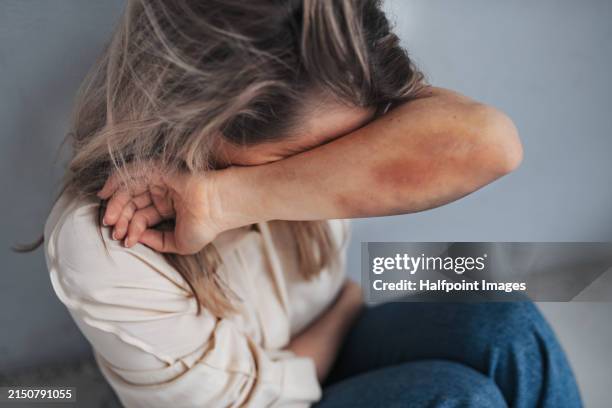 portrait of woman with bruises on arms, feeling hopeless, having problems with harassment in work. desperate abused woman showing her hands. domestic violence and abuse, sexual harassment. - gewalt gegen frauen stock-fotos und bilder