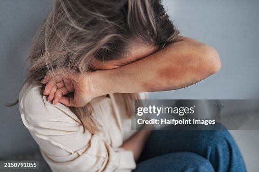 Portrait of woman with bruises on arms, feeling hopeless, having problems with harassment in work. Desperate abused woman showing her hands. Domestic violence and abuse, sexual harassment. Portrait of woman with bruises on arms, feeling hopeless, having problems with harassment in work. Desperate abused woman showing her hands. Domestic violence and abuse, sexual harassment.