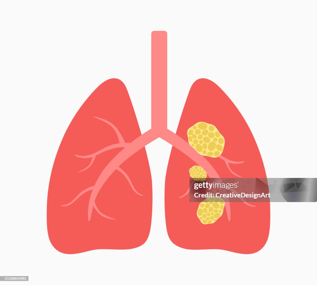 Human Lung With Cancer Tissue