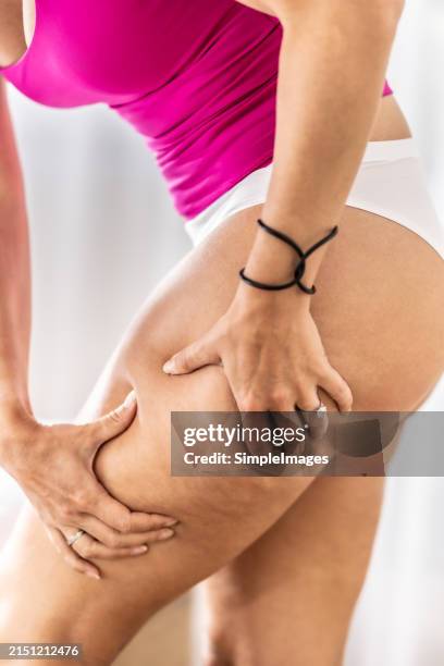 a young woman is checking her legs in the bedroom because she has symptoms of cellulite. partially naked woman. - cellulite stock pictures, royalty-free photos & images