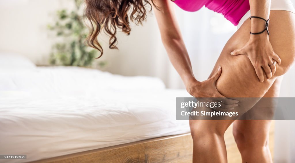 A young woman is checking her legs in the bedroom because she has symptoms of cellulite. Partially naked woman.