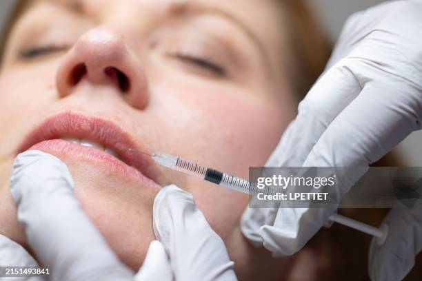 lippenfüller - schönheitsoperation stock-fotos und bilder