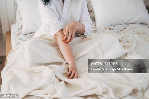 sensitive skin allergic concept, woman itching on her arm have a red rash from allergy symptom and from scratching. - zanzara foto e immagini stock