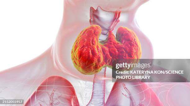 enlarged thyroid gland, 3d illustration - hyperthyroidism stock illustrations