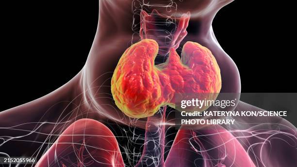 enlarged thyroid gland, 3d illustration - hyperthyroidism stock illustrations