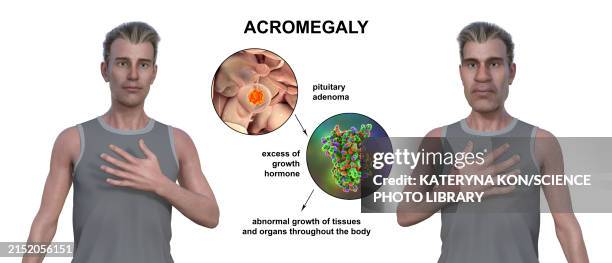 acromegaly, 3d illustration - distorted body stock illustrations
