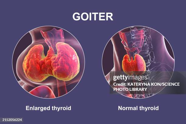 enlarged thyroid gland, 3d illustration - goiter stock illustrations