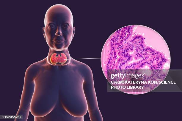 toxic goitre of thyroid gland, 3d illustration - goiter stock illustrations