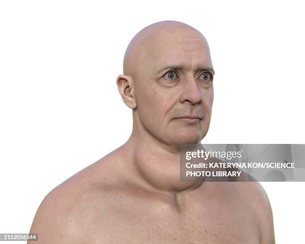 enlarged thyroid gland and protruding eyes, 3d illustration - hyperthyroidism stock illustrations