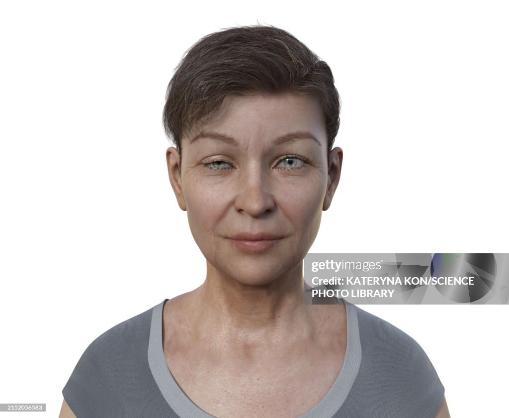 Woman with ptosis, illustration