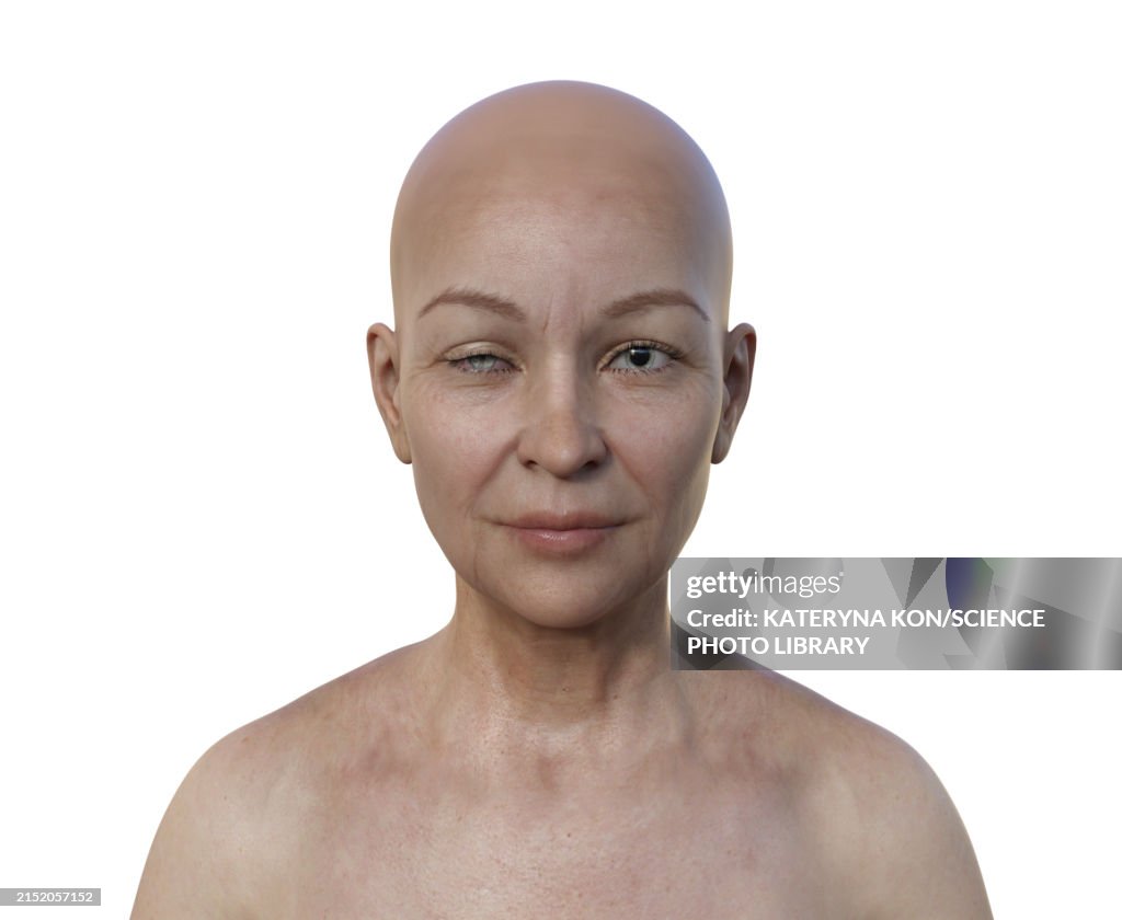 Woman with Horner syndrome, illustration