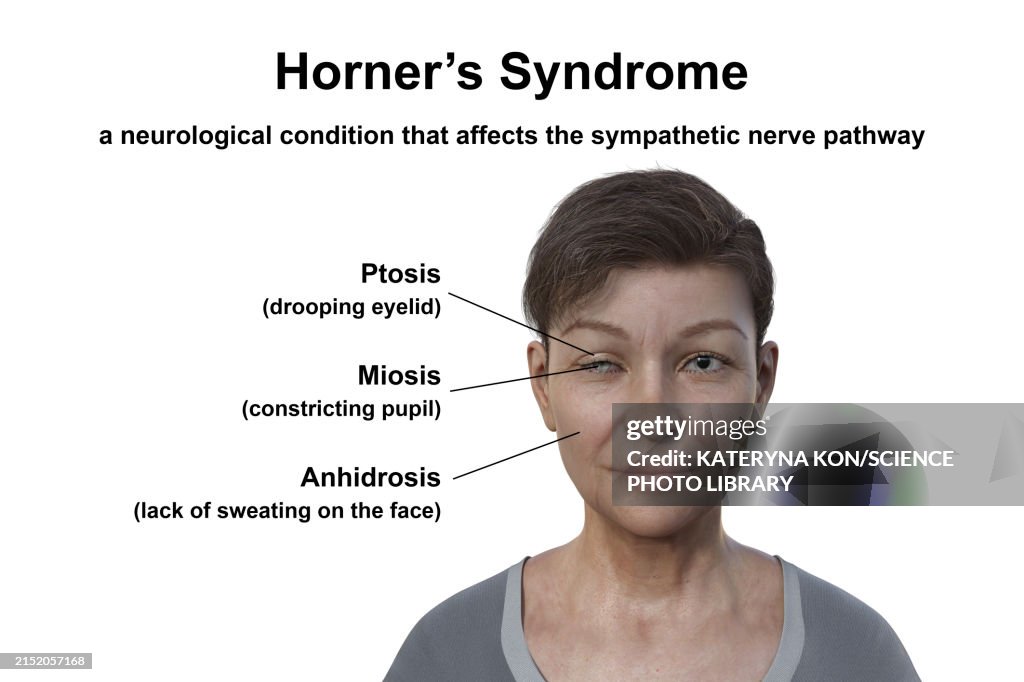 Woman with Horner syndrome, illustration