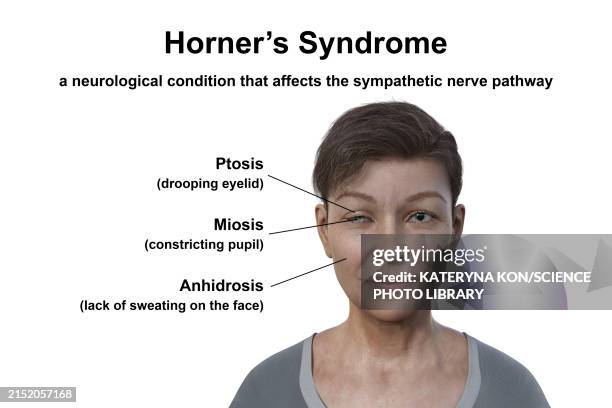 woman with horner syndrome, illustration - ptosis stock illustrations