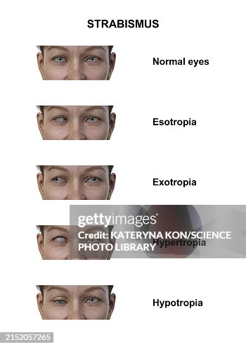 Woman With Various Strabismus Types Illustration High-Res Vector ...