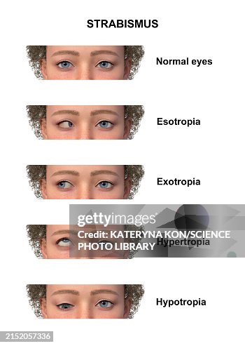 Child With Various Strabismus Types Illustration High-Res Vector ...