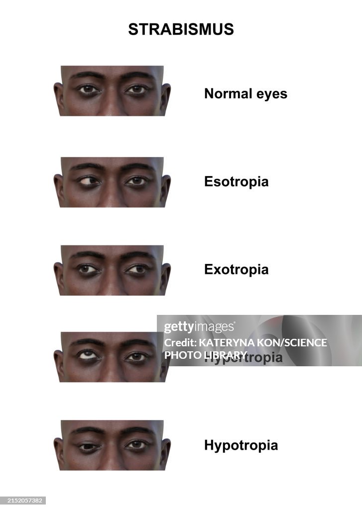 Strabismus Vision Example Man With Various Strabismus Types Illustration High-Res Vector Graphic ...