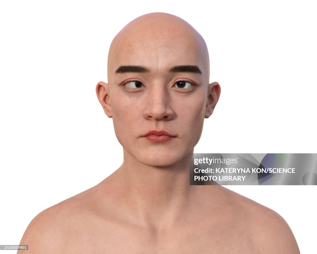 Sortopi Man With Esotropia Illustration High-Res Vector Graphic - Getty Images