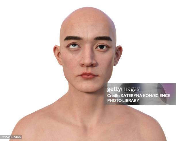 man with hypertropia, illustration - strabismus stock illustrations