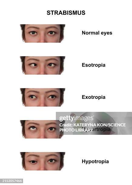 woman with various strabismus types, illustration - strabismus stock illustrations