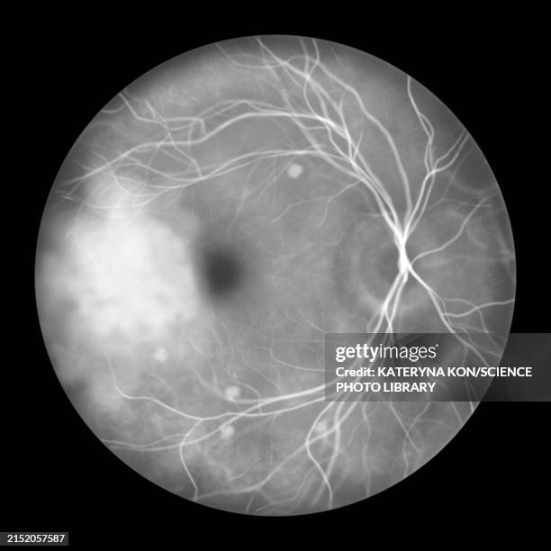 retina affected by blastomycosis, illustration - scientific imaging technique stock illustrations