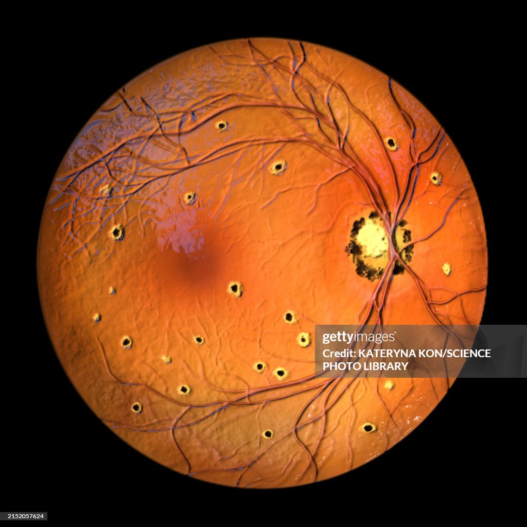 Flecks Rettine Retina Affected By Ocular Histoplasmosis Syndrome Illustration High-Res ...