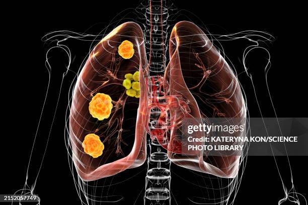 pulmonary blastomycosis, 3d illustration - dermatitis stock illustrations