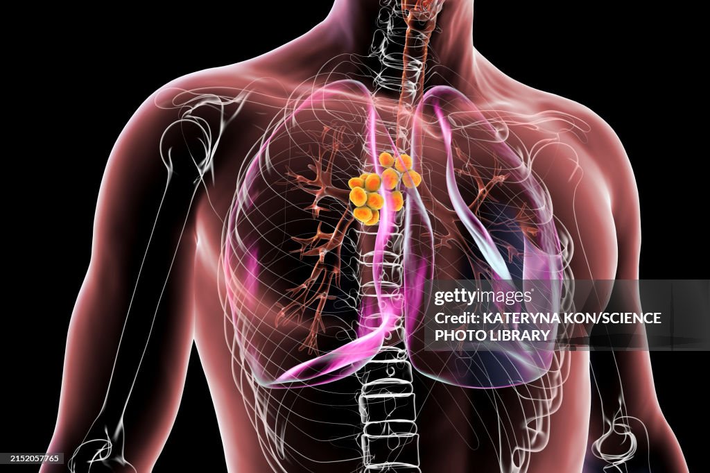 Mediastinal lymphadenopathy, 3D illustration