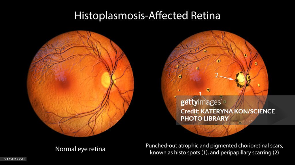 Flecks Rettine Retina Affected By Ocular Histoplasmosis Syndrome Illustration High-Res ...