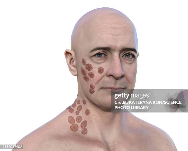 cutaneous blastomycosis, 3d illustration - skin problems face stock illustrations