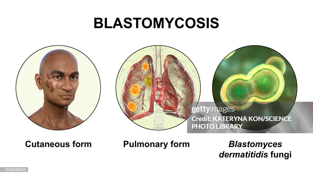 Clinical Presentations Of Blastomycosis 3d Illustration High-Res Vector ...