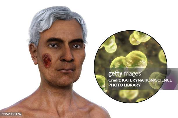 cutaneous blastomycosis, 3d illustration - dermatitis stock illustrations