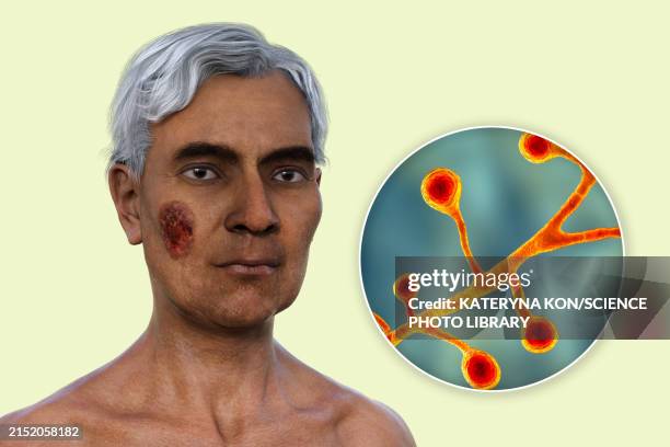 cutaneous blastomycosis, 3d illustration - pilzkopf stock-grafiken, -clipart, -cartoons und -symbole