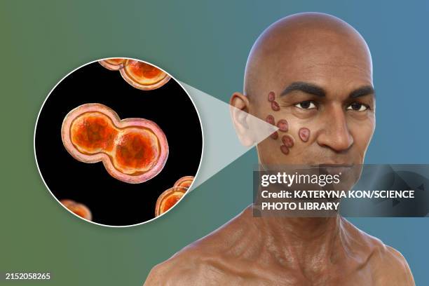cutaneous blastomycosis, 3d illustration - pilzkopf stock-grafiken, -clipart, -cartoons und -symbole