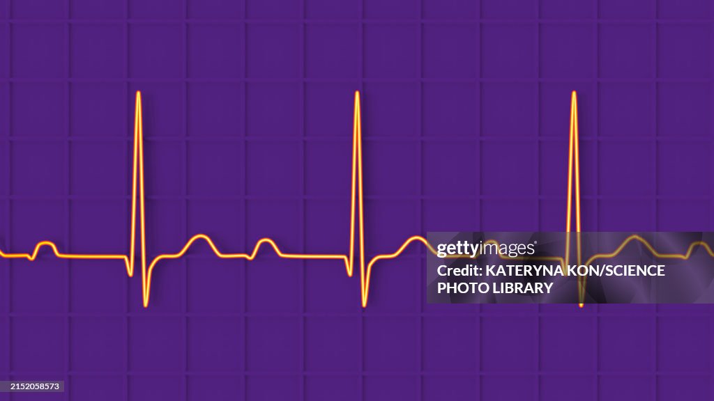 First Ecg Line Ecg Displaying First Degree Av Block Illustration High-Res Vector ...