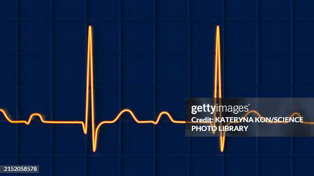 ecg displaying first degree av block, illustration - av stock illustrations