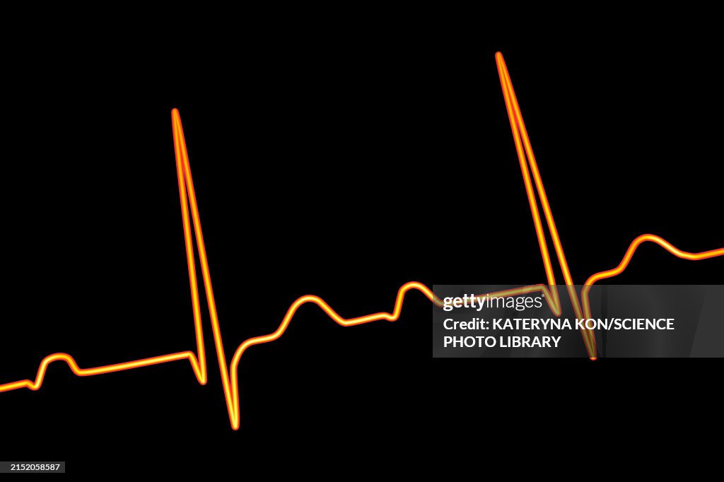 First Ecg Line Ecg Displaying First Degree Av Block Illustration High-Res Vector ...