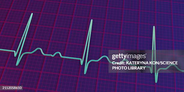 ecg displaying first degree av block, illustration - av stock illustrations