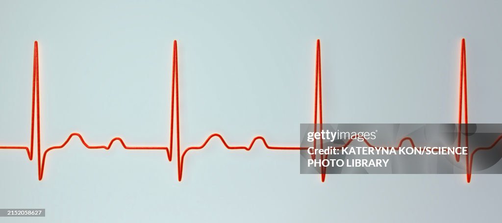 First Ecg Line Ecg Displaying First Degree Av Block Illustration High-Res Vector ...