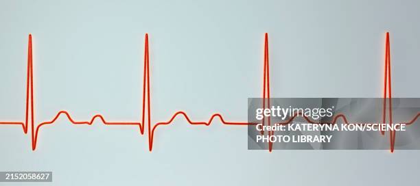 ecg displaying first degree av block, illustration - av stock illustrations