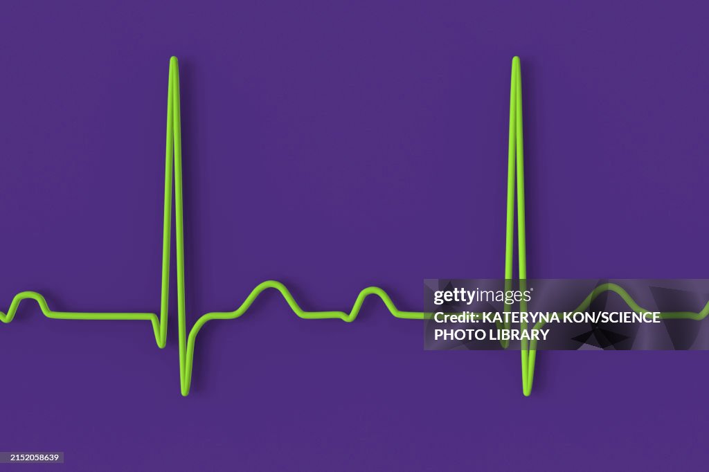 First Ecg Line Ecg Displaying First Degree Av Block Illustration High-Res Vector ...
